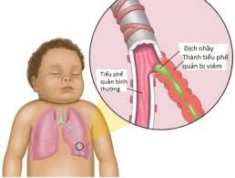 Tìm hiểu 5 nguyên nhân gây viêm phổi ở trẻ mới nhất.