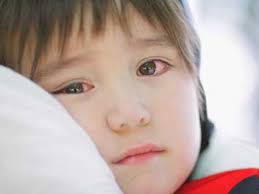 Tìm hiểu Bệnh đau mắt đỏ trẻ em cách điều trị hiệu quả và nhanh nhất mới nhất.