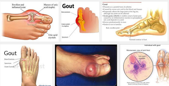 Cách làm Bệnh Gout là gì? Hiểu như thế nào là bệnh Gout cho đúng ngon.