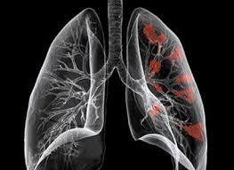 Cách làm Bệnh ung thư phổi di căn biểu hiện như thế nào ? ngon.