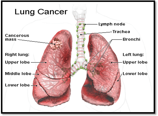 Cách làm Những dấu hiệu nhận biết ung thư phổi giai đoạn đầu ngon.