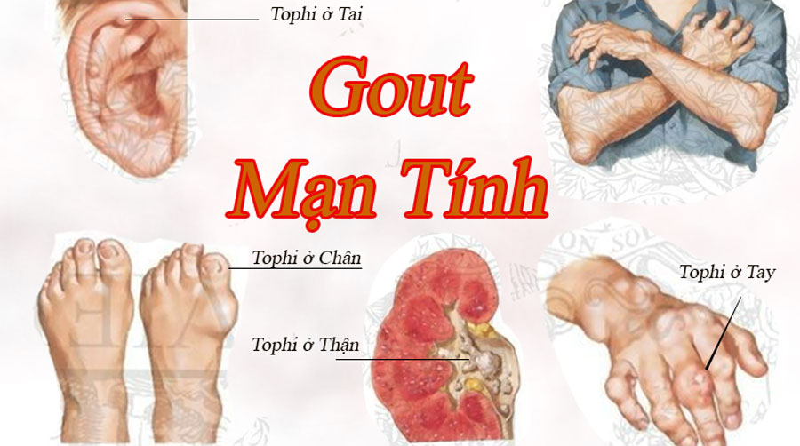 Hướng dẫn cách làm Tổng hợp Top 10 nguyên nhân chính gây ra bệnh Gout ngon.