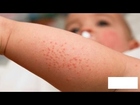 Thông tinBệnh sốt xuất huyết ở trẻ em và cách phòng bệnh sốt xuất huyết cho trẻ hay.