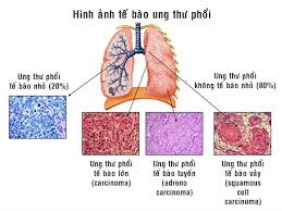 LàmBệnh ung thư phổi có trị được không ? tại nhà.