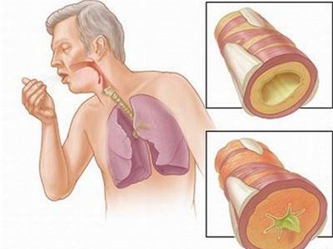 LàmNhững dấu hiệu nhận biết ung thư phổi giai đoạn đầu tại nhà.